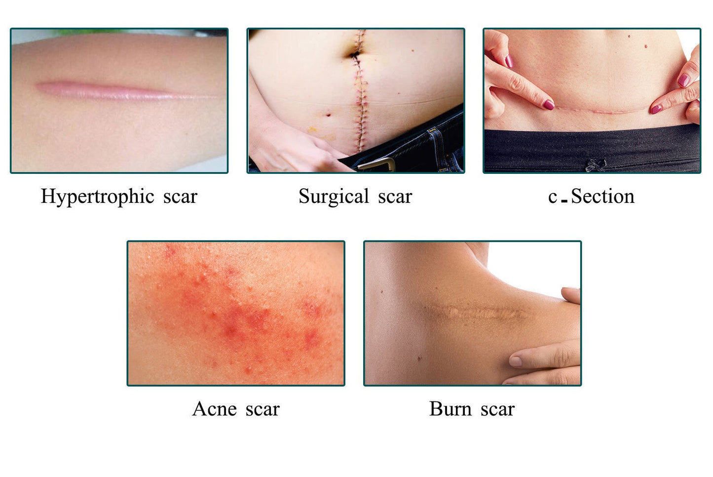 Silicone Scar Sheets (4*150cm, Brown color) | Scar Repair Tapes for New & Old Scars and Stretch Marks